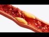 Salute: nuove linee guida dislipidemie, ‘abbassare e stabilizzare colesterolo’
