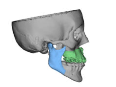 Molinette, ricostruzione del volto con tecnologia 3d ad un 23enne Molinette ricostruzione del volto