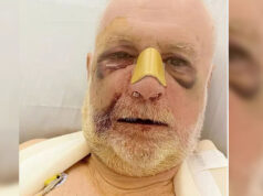 Aggredito in corso Francia lo psichiatra Enrico Borla, probabile “knockout game” Enrico Borla aggredito