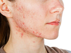 Vaiolo delle scimmie, virus e sintomi: cosa c’è da sapere vaiolo