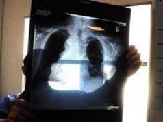 Tumori, con screening polmonare +7 anni sopravvivenza e risparmi per 2,3 mld