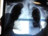 Cancro al polmone aggressivo, combinazione farmaci riduce del 58% rischio morte