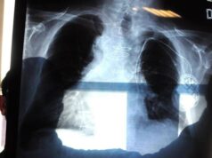 Cancro al polmone aggressivo, combinazione farmaci riduce del 58% rischio morte