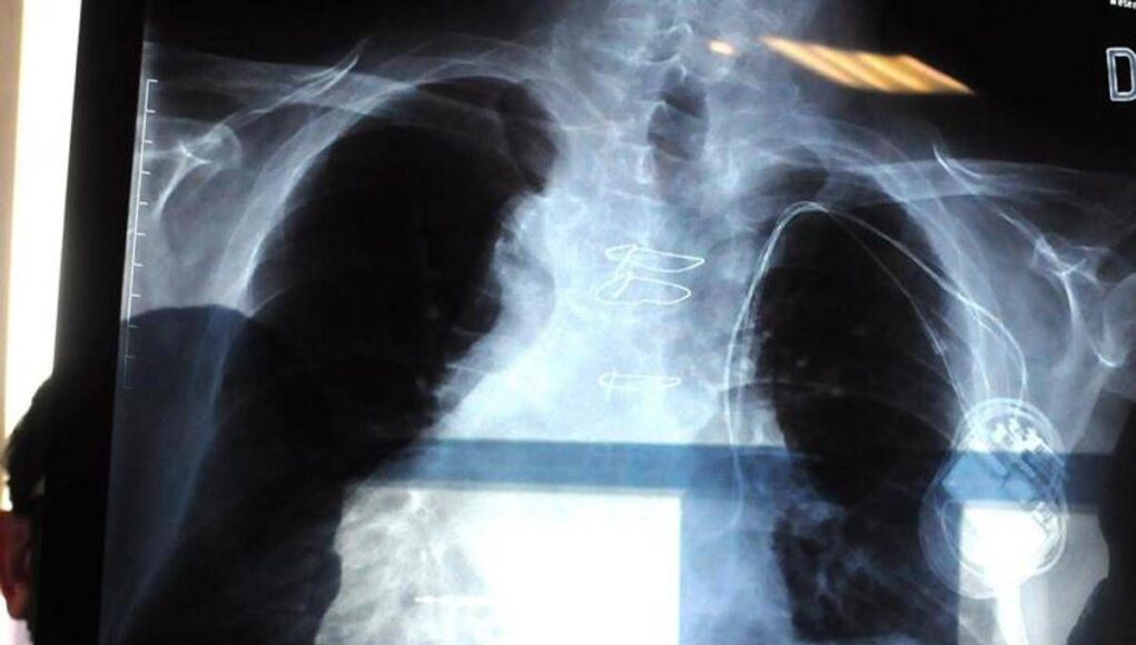 Polmonite, ogni anno in Italia 150mila ricoveri e 9mila morti: i sintomi