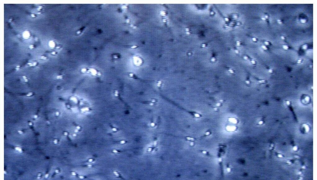 Microplastiche nella prostata e nel liquido seminale, la scoperta italiana: cosa comporta