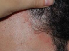 Costanzo (Humanitas): “Jak inibitori utili in comorbidità di dermatite atopica”