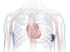 Salute, esperto: “Defibrillatore innovativo poco invasivo evita complicanze sistema venoso”