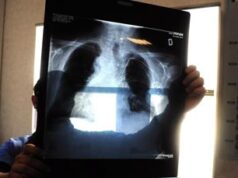 Tumori, in Italia 395mila casi nel 2023, ondata diagnosi post pandemia e -3% screening