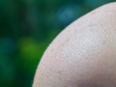 Cos’è il melanoma? Sintomi, prevenzione e successi dell’immunoterapia