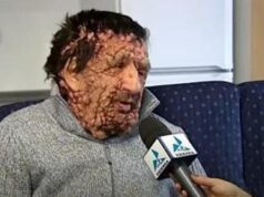 Morto Vinicio Riva, l’uomo sfigurato abbracciato da Papa Francesco