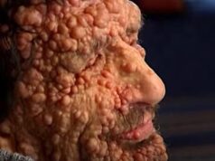 Neurofibromatosi, il morbo che deturpa il volto: ecco la malattia che ha commosso il Papa