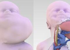 Appena nato salvato da intervento alla gola, massa tumorale impediva respiro