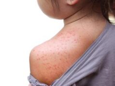 Morbillo, italiani creano database mondiale pubblico con dati aggiornati