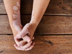 Vitiligine, Manifesto per 330 mila pazienti in Italia