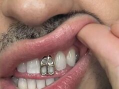 Gioielli sui denti, è grillz mania: possibili rischi