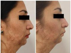 La storia di Pinky, bruciata dal marito e oggi rinata grazie al progetto RigeneraDerma