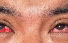 Aviaria, ecco i sintomi del primo uomo infettato