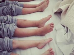 Dal ginocchio valgo al piede piatto, i difetti nei bimbi: cosa fare e quando preoccuparsi