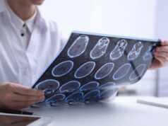 Sclerosi multipla, Aism presenta 30 proposte per contrastare la Sm