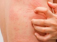 Fake news sull’orticaria, l’immunologo: “Diffidare dai test farlocchi”