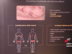 Idrosadenite suppurativa, l’esperto: “Più attenzione a qualità della vita”