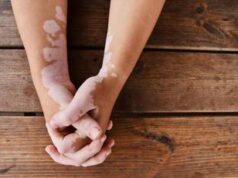 Salute, dermatologo Paro Vidolin: “Per vitiligine dopo 40 anni abbiamo un farmaco”