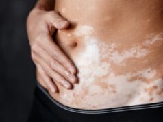 Vitiligine, dermatologo Paro Vidolin: “Sì al sole ma con creme per patologia”