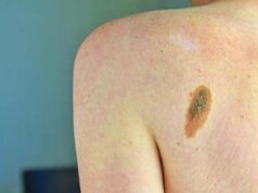 Ok Aifa a immunoterapia in fase precoce per melanoma e carcinoma polmonare