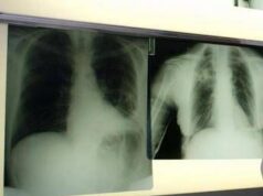 Cancro polmone a piccole cellule, ok Ue a tislelizumab