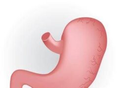 Caldo peggiora sintomi del reflusso, in casi gravi “chirurgia opzione risolutiva”