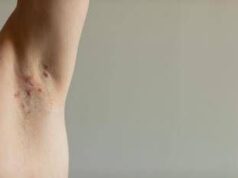 Idrosadenite suppurativa, appello esperti ‘sia inserita nel Piano delle cronicità ’