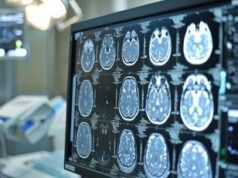 Neoplasie cerebrali, in Italia ogni anno 3mila casi di glioma