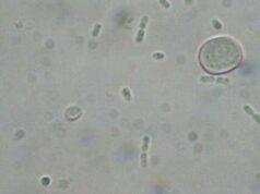 Batterio mangiacarne uccide 4 persone, Bassetti: “Colpa del clima”