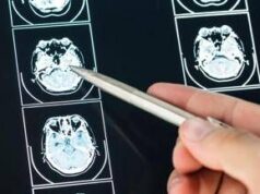 Intelligenza Artificiale può prevedere evoluzione Parkinson, lo studio italiano