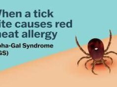 Se una zecca rende allergici a carne e latticini, cos’è la sindrome alfa-gal