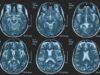 Tumori, glioma pediatrico di basso grado: via libera in Europa a prima terapia mirata