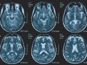 Tumori, glioma pediatrico di basso grado: via libera in Europa a prima terapia mirata