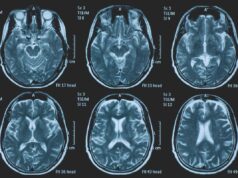 Tumori, glioma pediatrico di basso grado: via libera in Europa a prima terapia mirata