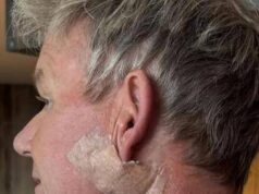 Gordon Ramsay: “Operato per tumore della pelle”