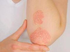 Giornata della psoriasi, Ucb conferma il suo impegno a fianco dei pazienti