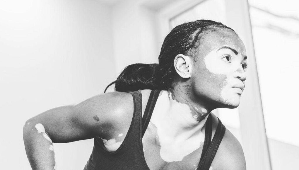 Vitiligine, “così la terapia della luce aiuta il farmaco”