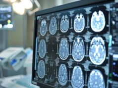 Ictus, esperti: “Asundexian apre nuovo capitolo prevenzione secondaria”