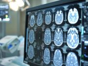 Sanità, presentato Deestrategy, modello per continuità assistenziale in encefalopatie rare