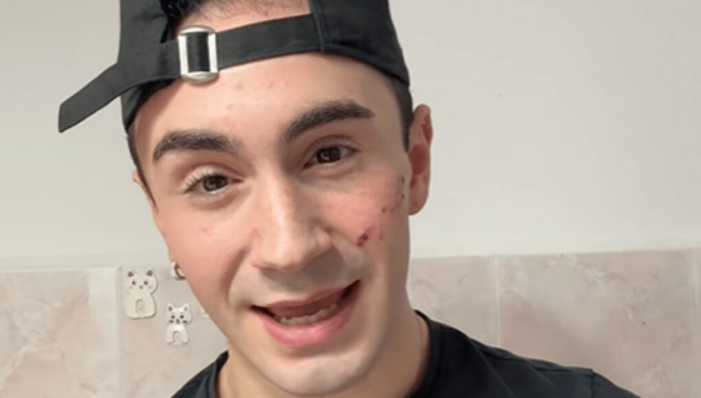 Genova, 19enne denuncia aggressione omofoba: “Sfregiato al viso con coltellino”