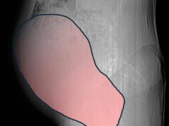 Intervento record al Sant’Anna di Torino, rimosso tumore ovarico di 6 kg