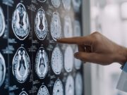 Neurologi: “Per tumori cerebrali la svolta della medicina di precisione”