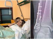 Thais Wiggers, operazione alla caviglia dopo incidente: “Comincio anno con un piede bionico”