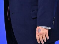 Trump e il nuovo livido sulla mano, tutte le ipotesi secondo Bassetti