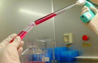 Melanoma uveale metastatico: “Tebentafusp raddoppia sopravvivenza a 5 anni”