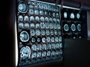 Uno spray nasale ferma l’invecchiamento del cervello, lo studio